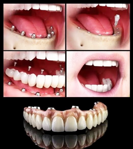 Dental Implant