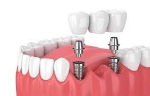 Dental Implant 1