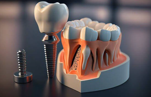 Dental Implant 2