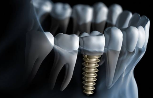 Dental Implant 3