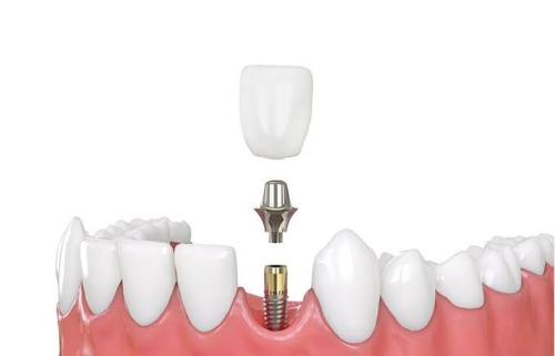 Dental Implant 4