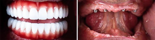 Dental Implant 5